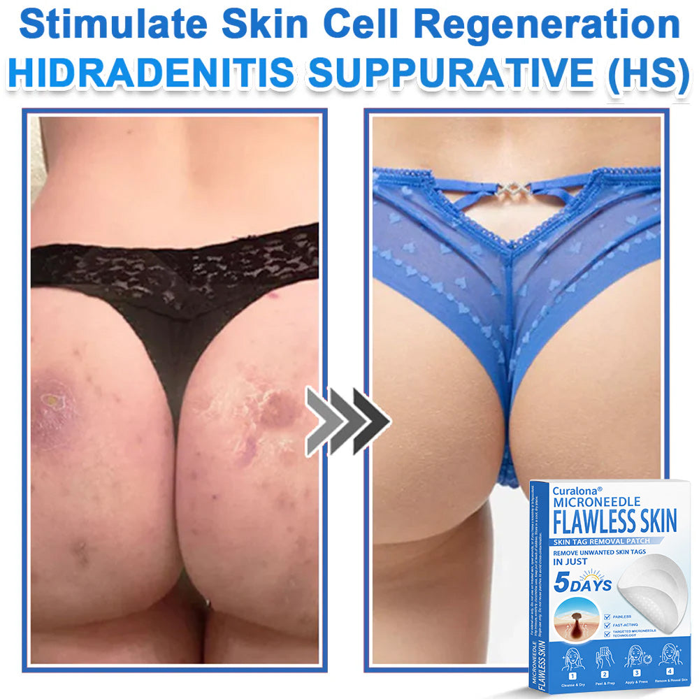 🩹 Curalona® 2-in-1 Microneedle & Hydrocolloid Patch | Raised Moles,Acne,  Flat Warts & Skin Tags Remover | Improves Wrinkles, Scars & Blemishes | Invisible Pimple Patches for Face & Body