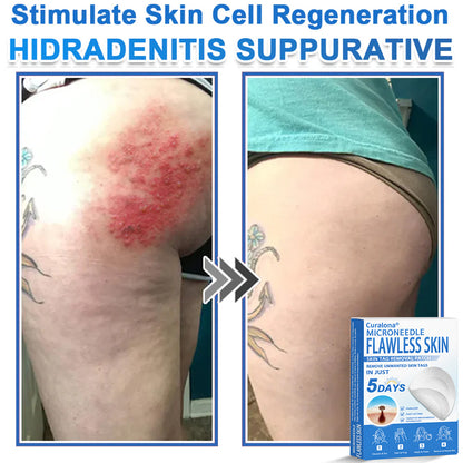 🩹 Curalona® 2-in-1 Microneedle & Hydrocolloid Patch | Raised Moles,Acne,  Flat Warts & Skin Tags Remover | Improves Wrinkles, Scars & Blemishes | Invisible Pimple Patches for Face & Body