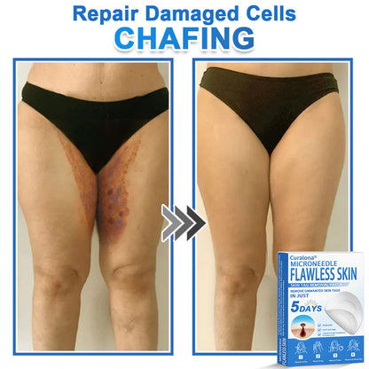 🩹 Curalona® 2-in-1 Microneedle & Hydrocolloid Patch | Raised Moles,Acne,  Flat Warts & Skin Tags Remover | Improves Wrinkles, Scars & Blemishes | Invisible Pimple Patches for Face & Body