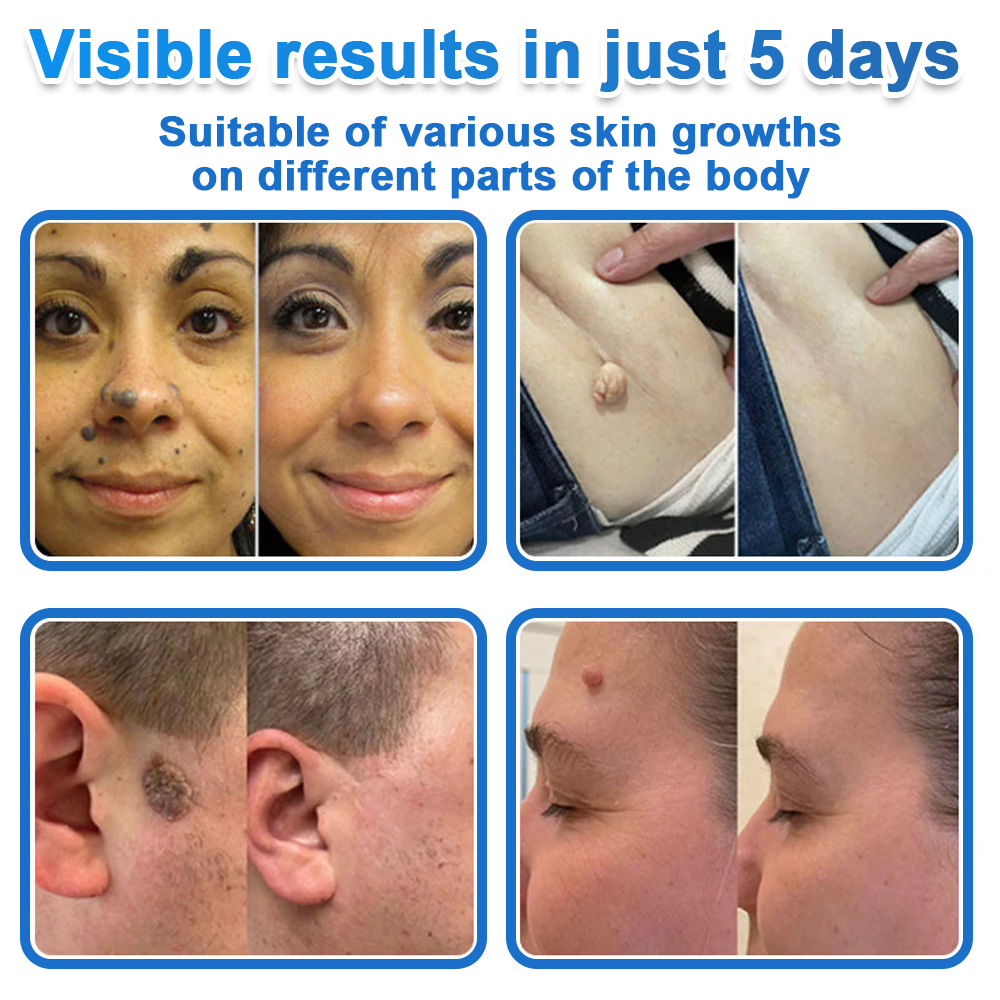 🩹 Curalona® 2-in-1 Microneedle & Hydrocolloid Patch | Raised Moles,Acne,  Flat Warts & Skin Tags Remover | Improves Wrinkles, Scars & Blemishes | Invisible Pimple Patches for Face & Body