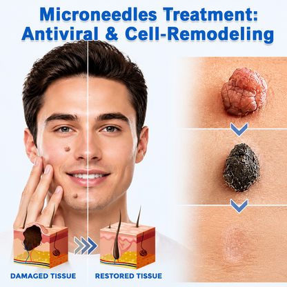 Curalona®2-in-1 Microneedle & Hydrocolloid Patch🍀| Removes Raised Moles, Acne, Flat Warts & Skin Tags | Helps Improve Wrinkles, Scars & Blemishes | Invisible Patches for Face & Body