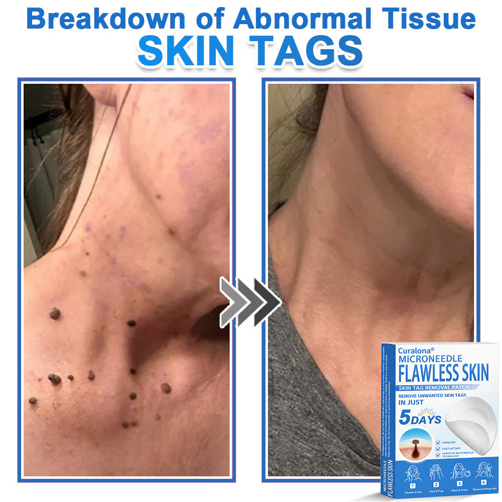 🩹 Curalona® 2-in-1 Microneedle & Hydrocolloid Patch | Raised Moles,Acne,  Flat Warts & Skin Tags Remover | Improves Wrinkles, Scars & Blemishes | Invisible Pimple Patches for Face & Body