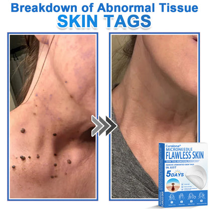 🩹 Curalona® 2-in-1 Microneedle & Hydrocolloid Patch | Raised Moles,Acne,  Flat Warts & Skin Tags Remover | Improves Wrinkles, Scars & Blemishes | Invisible Pimple Patches for Face & Body