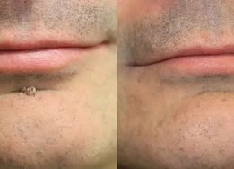 Curalona®2-in-1 Microneedle & Hydrocolloid Patch🍀| Removes Raised Moles, Acne, Flat Warts & Skin Tags | Helps Improve Wrinkles, Scars & Blemishes | Invisible Patches for Face & Body