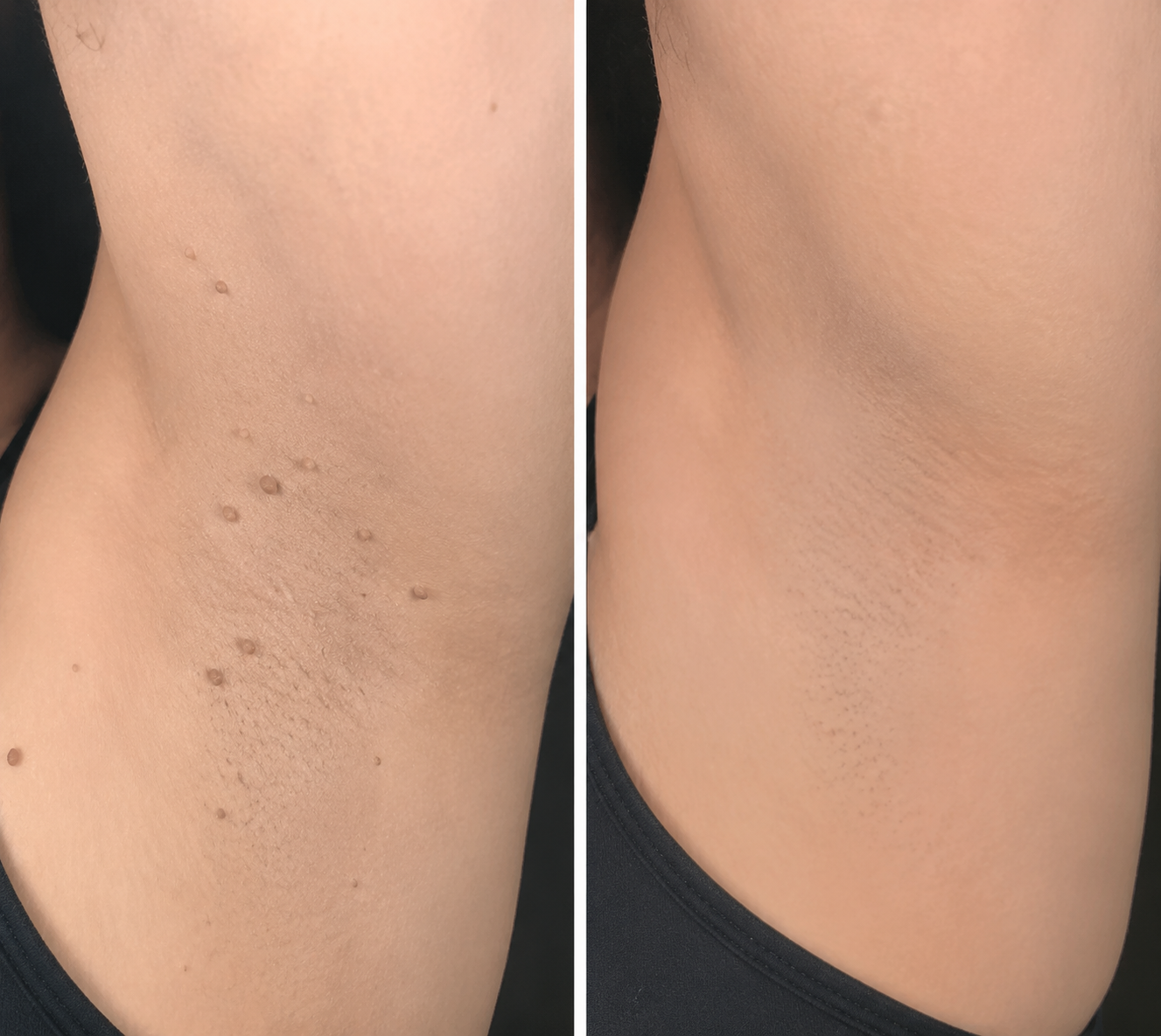 Curalona®2-in-1 Microneedle & Hydrocolloid Patch🍀| Removes Raised Moles, Acne, Flat Warts & Skin Tags | Helps Improve Wrinkles, Scars & Blemishes | Invisible Patches for Face & Body
