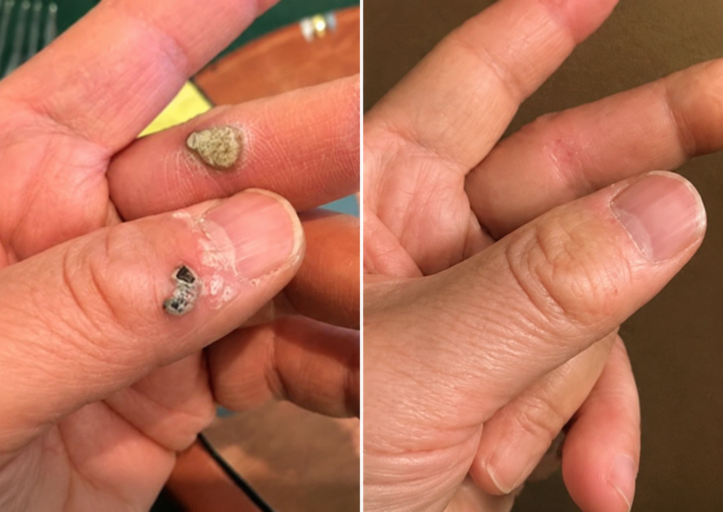 Curalona®2-in-1 Microneedle & Hydrocolloid Patch🍀| Removes Raised Moles, Acne, Flat Warts & Skin Tags | Helps Improve Wrinkles, Scars & Blemishes | Invisible Patches for Face & Body